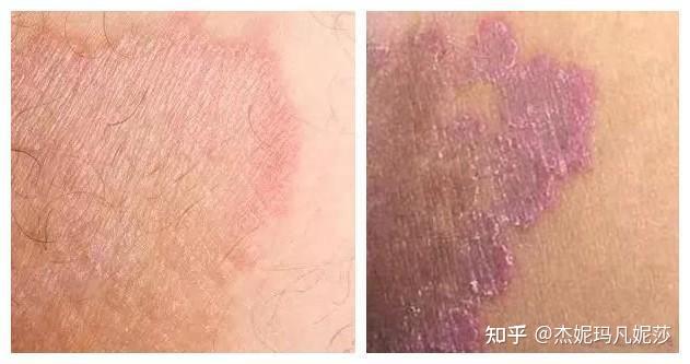 本人男18歲兩條大腿內側都有痘痘左側情況偏好一些癢求助