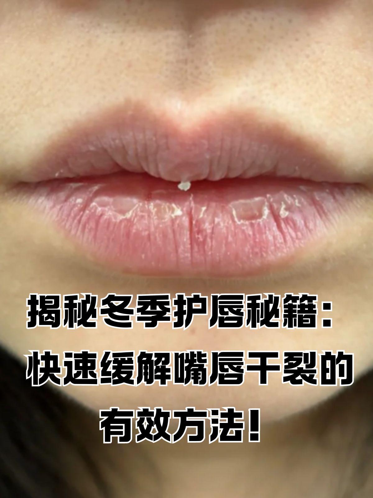 秋天,嘴唇总是干燥起皮裂开怎么办?