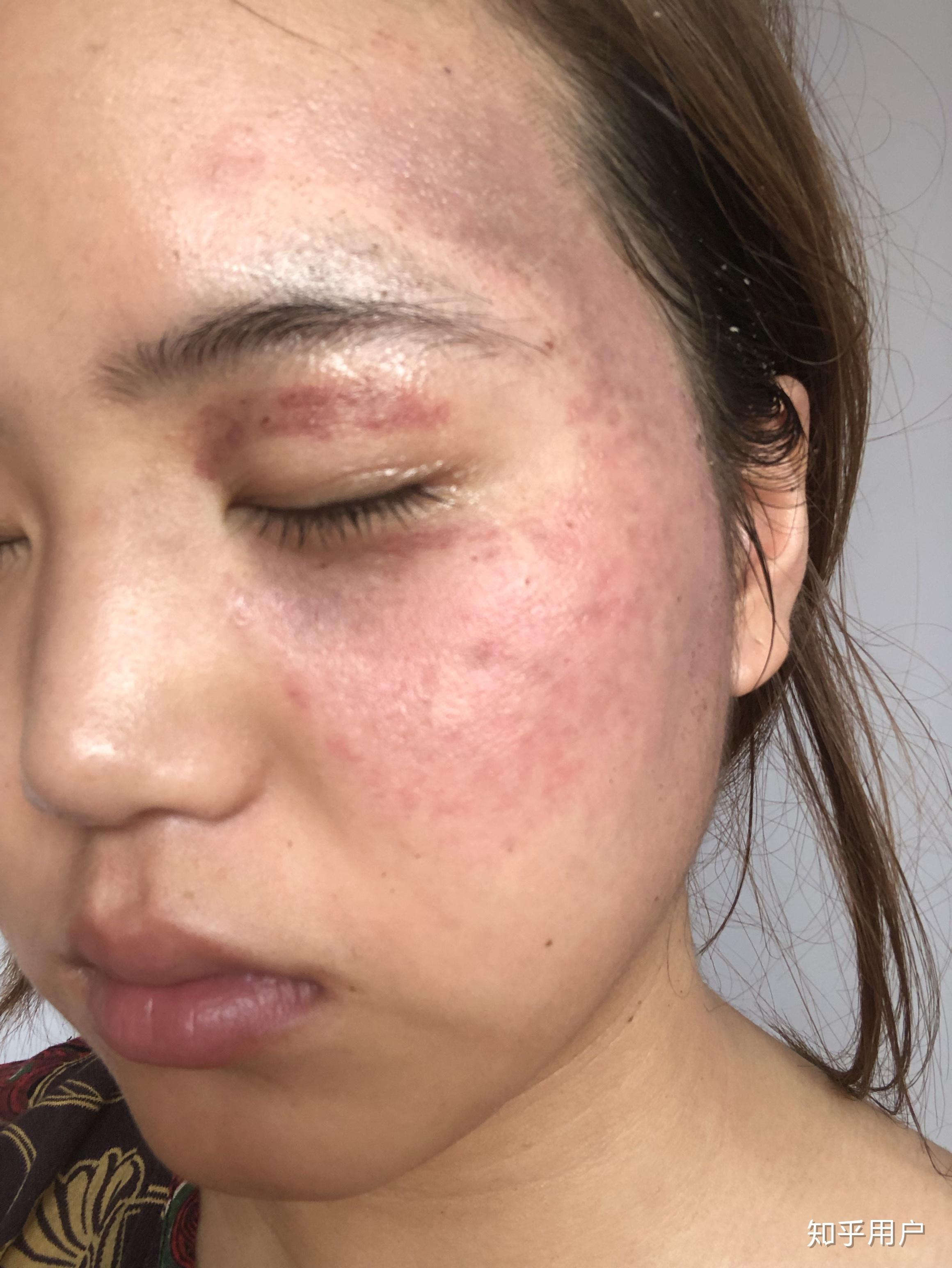 太田痣激光手术后几天可以见人呢