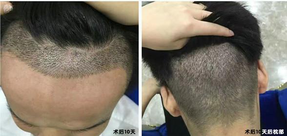 植发后清理血痂会掉毛囊吗? - 知乎