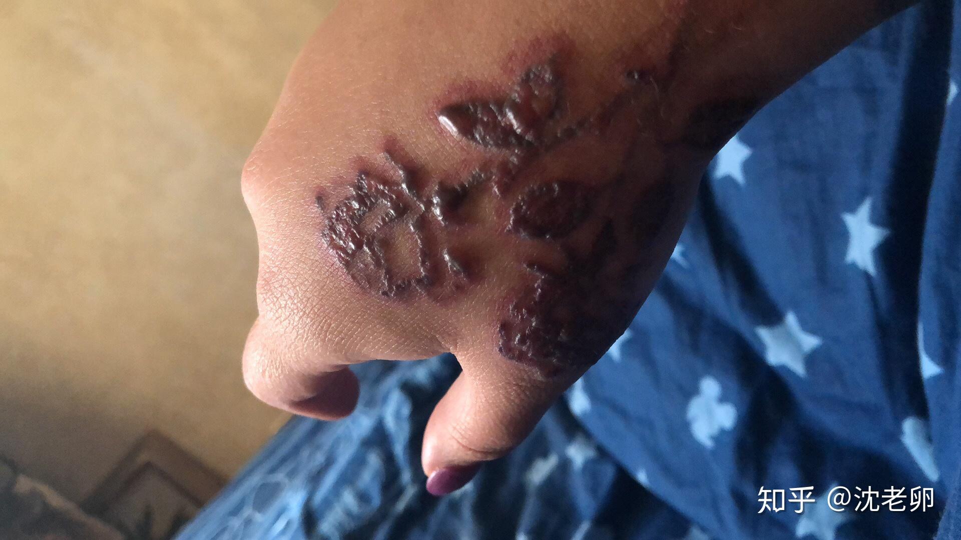 洗纹身起水泡了怎么办? - 知乎