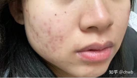 这个小东西能直接让你的痘印离家出走!