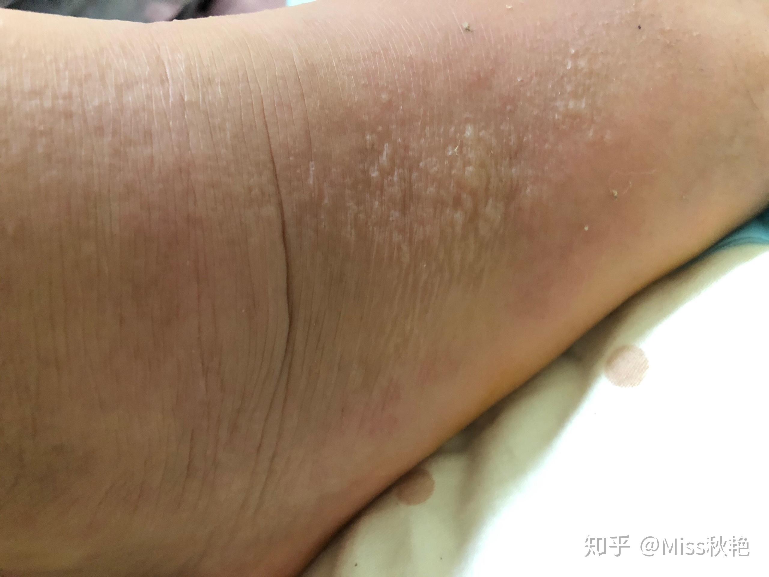过敏会起水泡吗 知乎