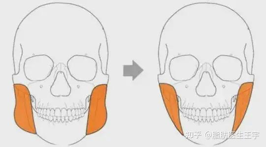“发腮”怎么办?如何解决? - 知乎