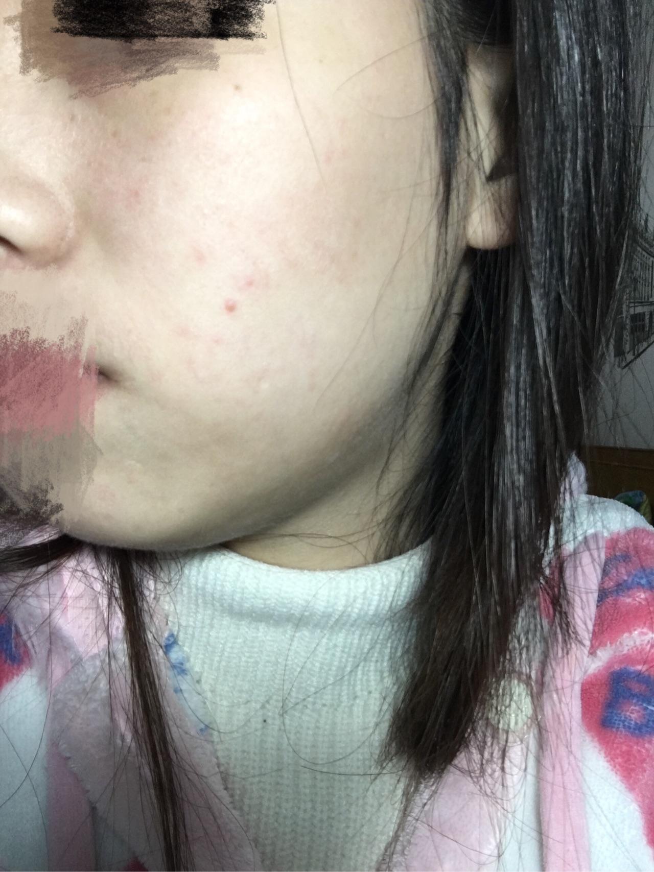 敏感体质的红血丝敏感肌肤如何护肤呢