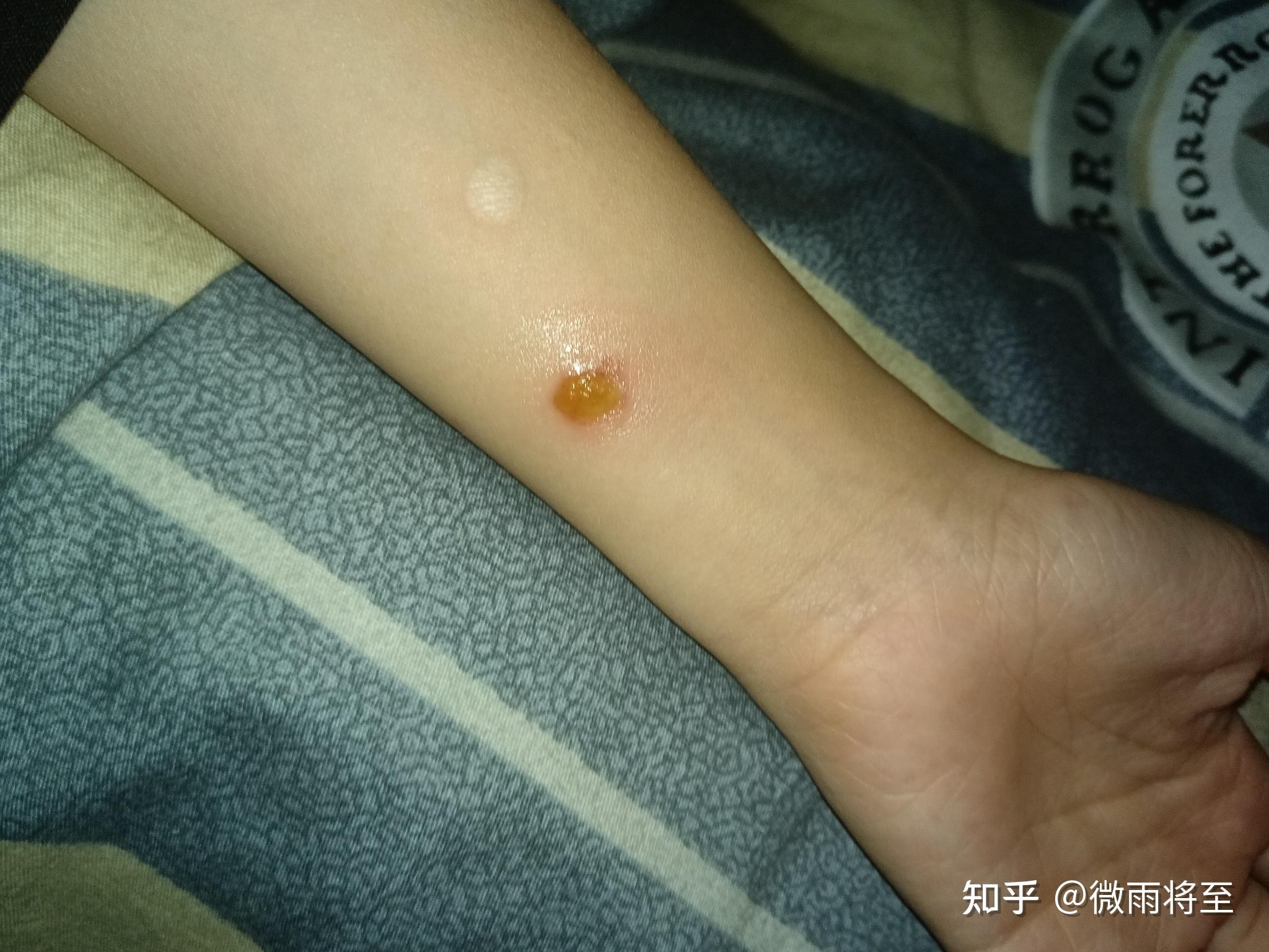 怎么彻底去除烟疤? - 知乎