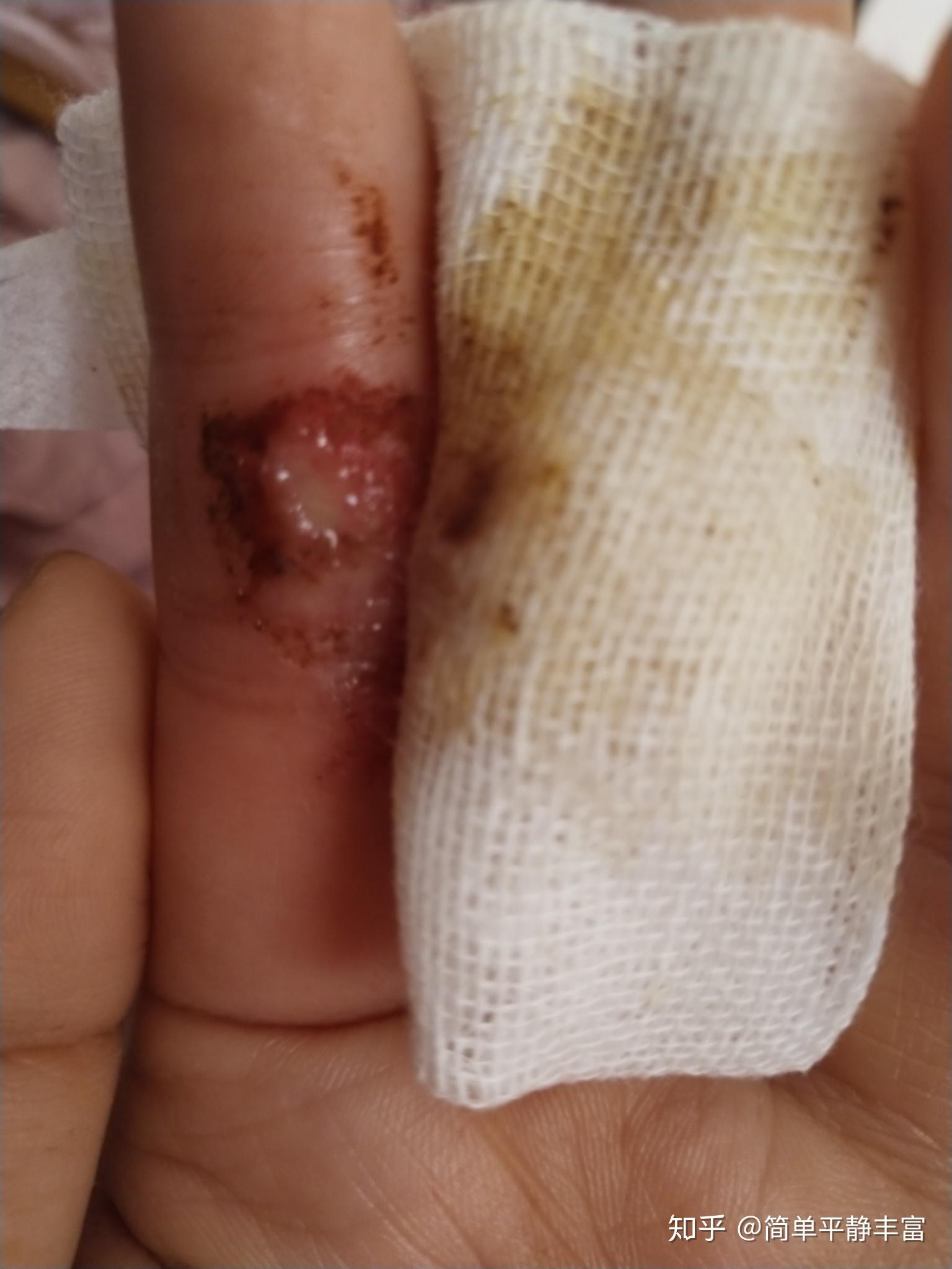 手指头扎了一个小刺刺弄不出来咋办