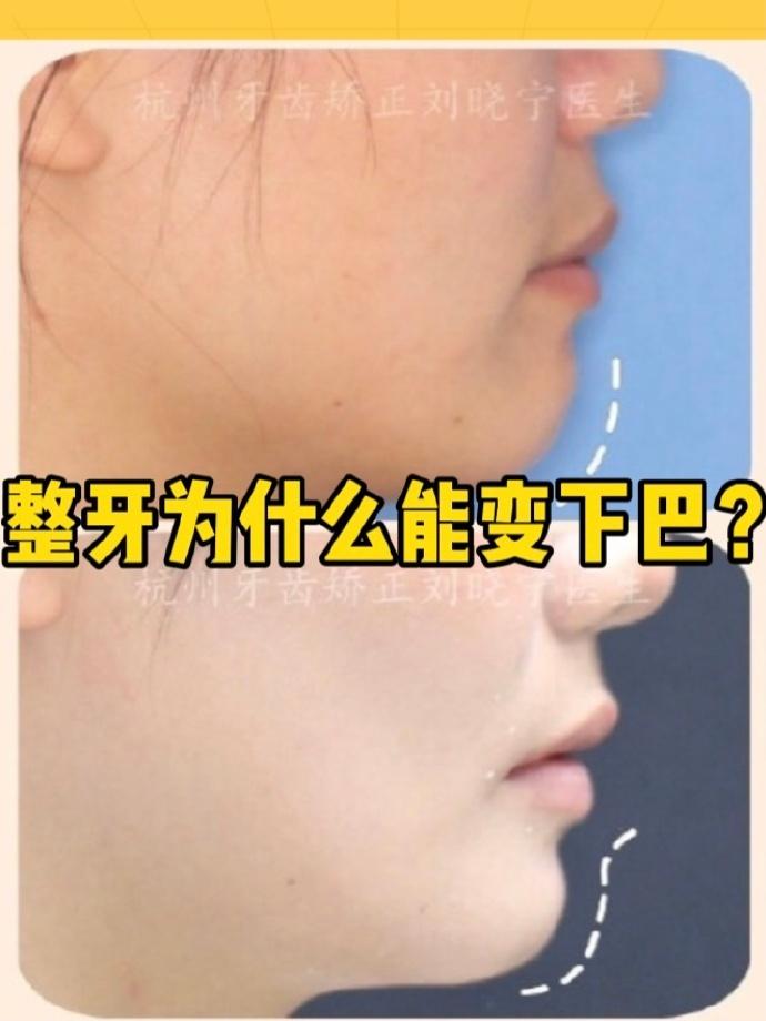 杭州牙齿矫正丨整牙为什么可以让下巴看起来更翘了