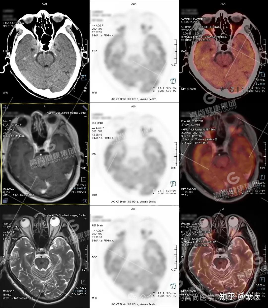 PET/CT-MR多模态发现肺癌脑转移 - 知乎