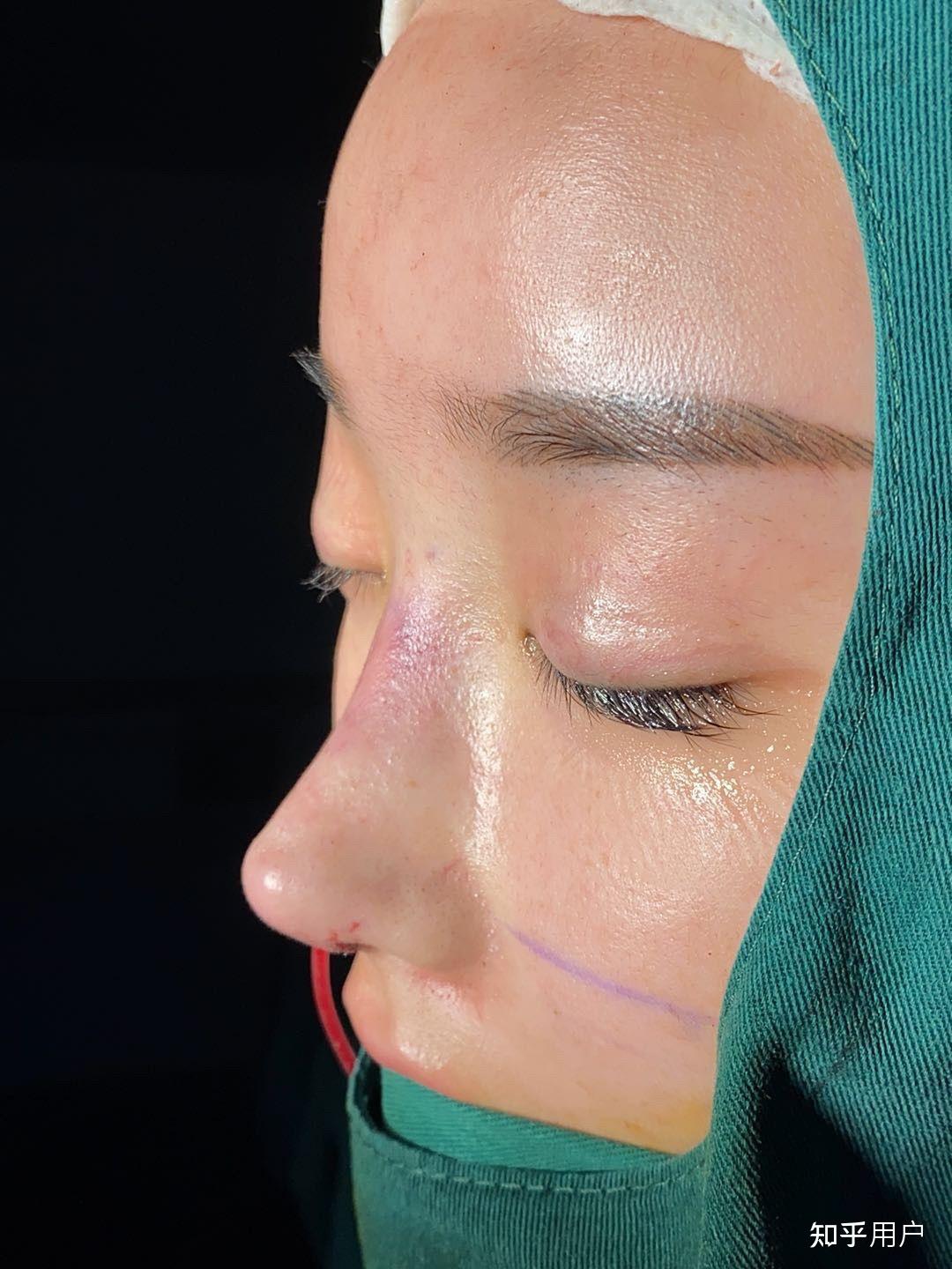 北京刘彦军,李劲良,胡俊峰,上海王艳戴传昌哪个鼻修复厉害点? - 知乎