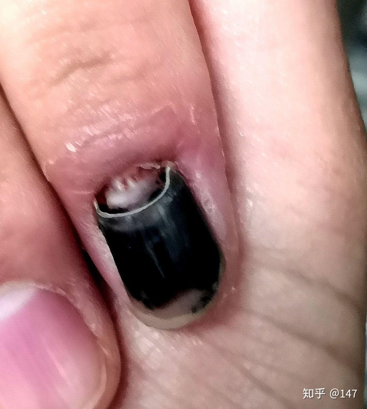 手指被门夹了,然后指甲里面四分之一有淤血,都两个月了还没好,怎么办?