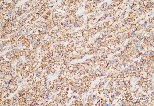 CD3、CD20…揭秘淋巴瘤免疫组化报告上的“CD家族” - 知乎