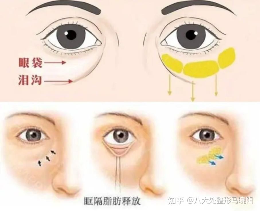 如何才能消除泪沟? - 知乎