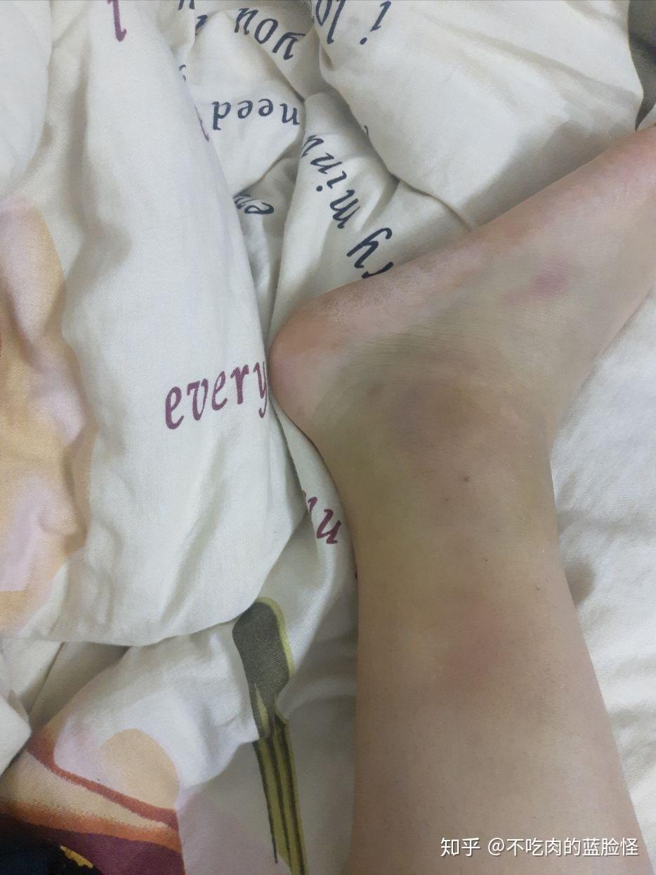 大家有没有严重崴脚的经验