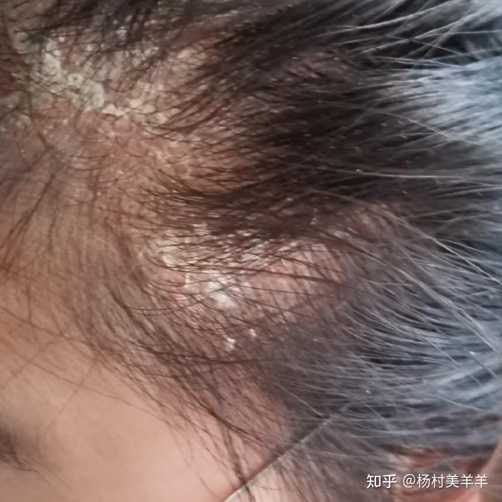 头皮上经常能抠下来大块白色的头屑,应该怎么办?