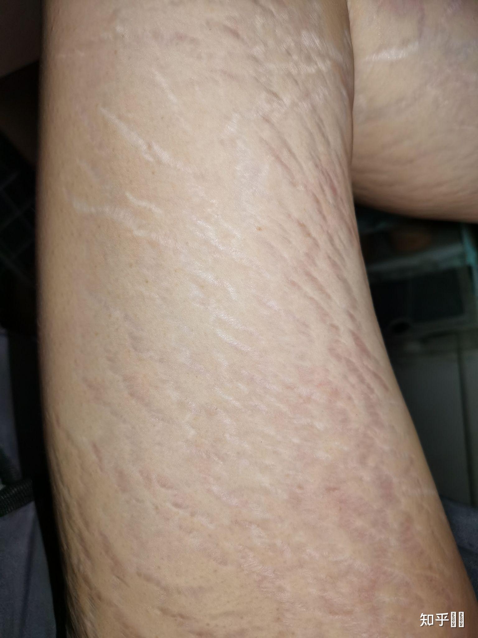 肥胖纹到底能不能去掉? - 知乎