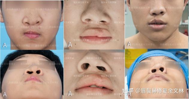 唇鼻修复术后多久可以正常上班? - 知乎