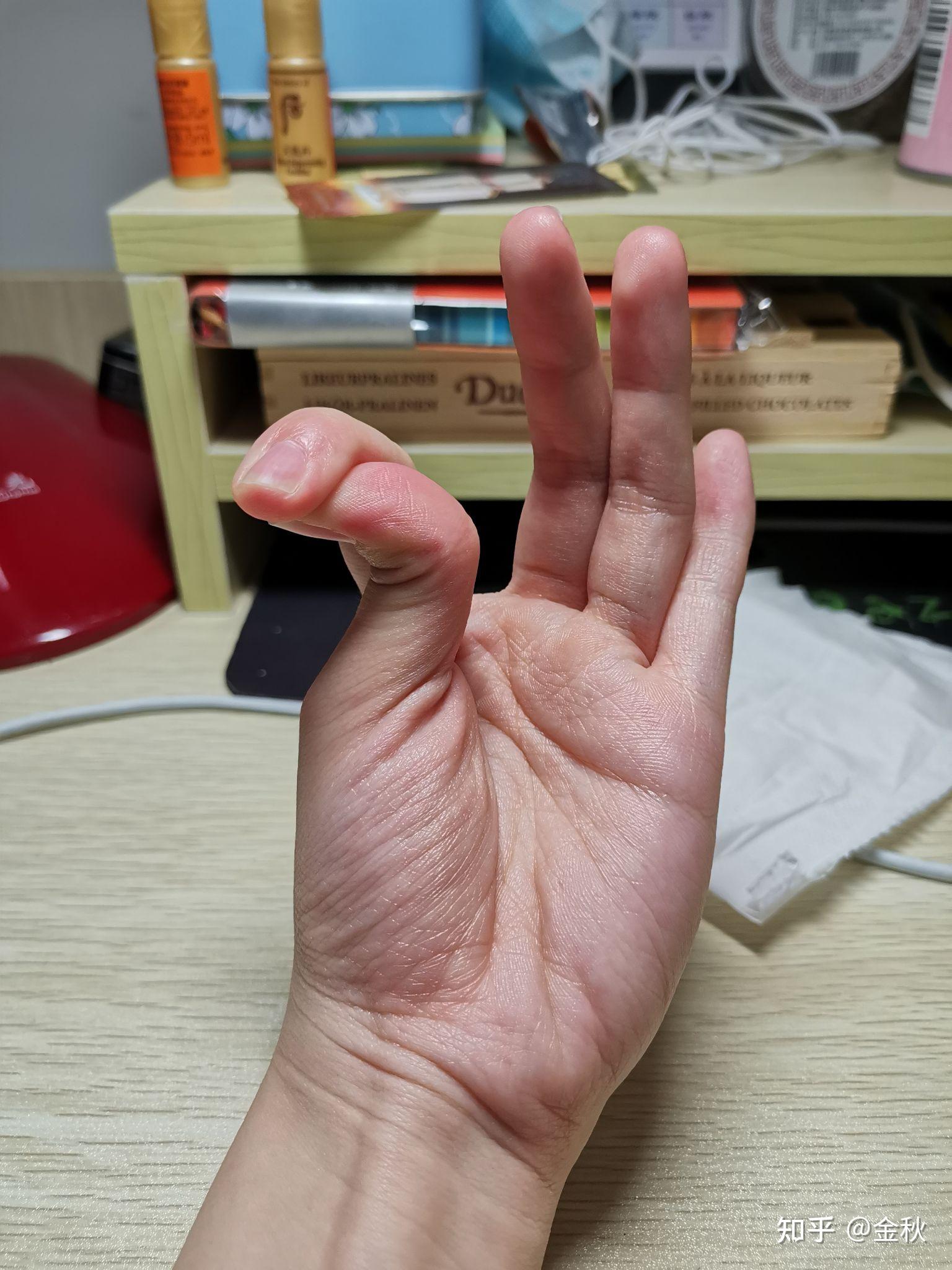 为什么有的人大拇指可以往后弯而有的人不行