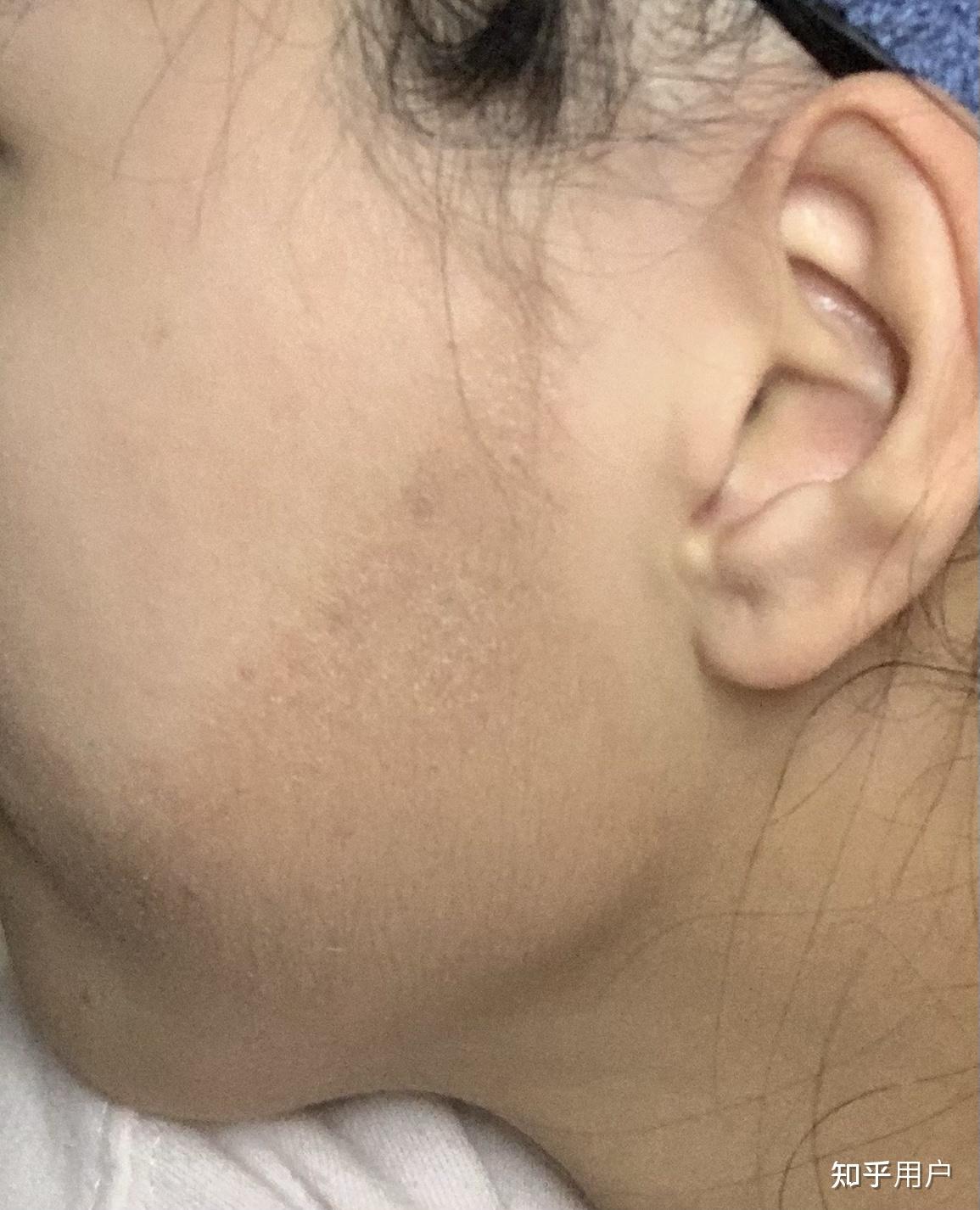 面颈毛囊红斑黑变病的致病原理已及治疗方法? - 知乎