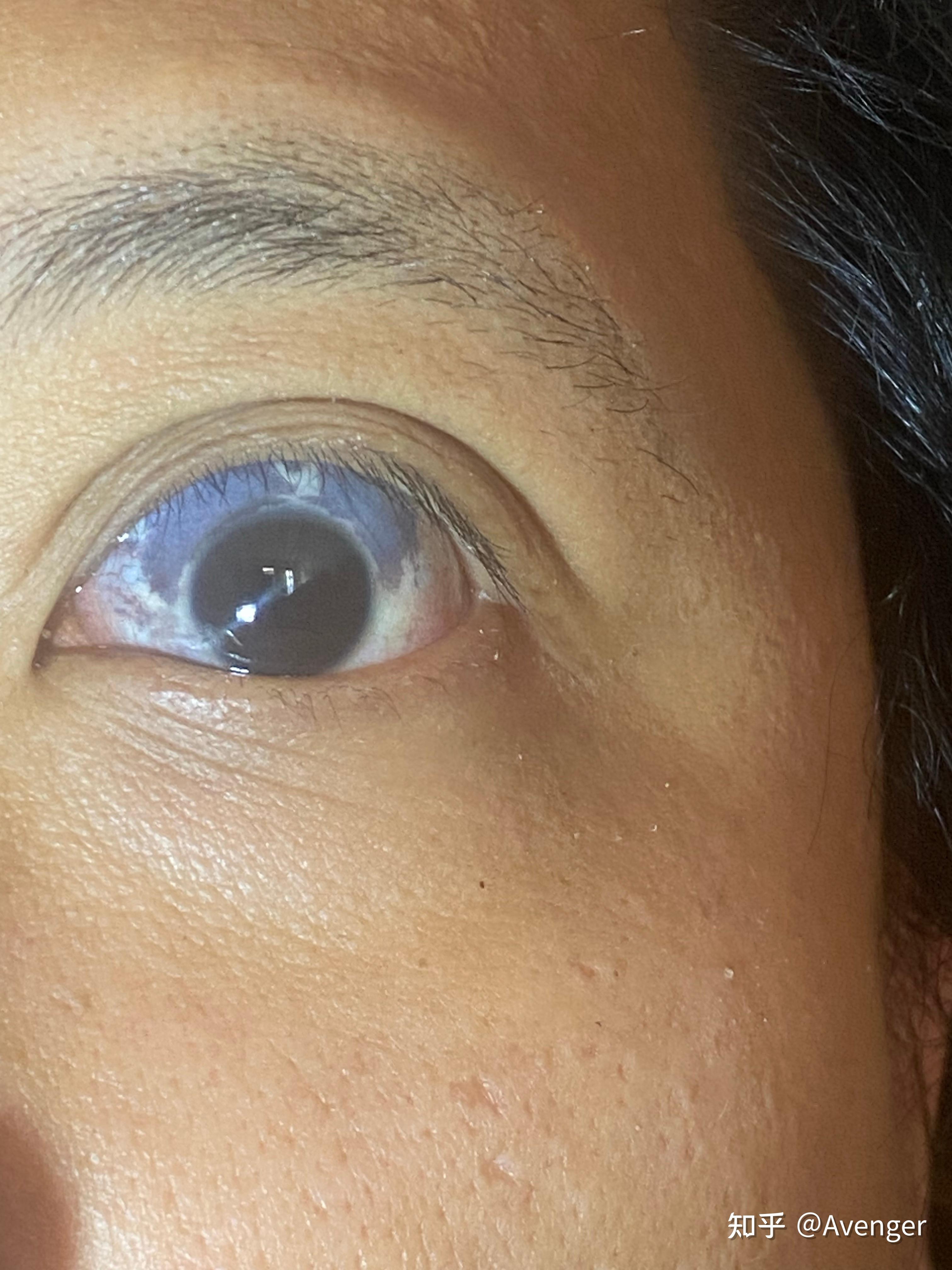 虹膜色素痣发作的原因是什么?