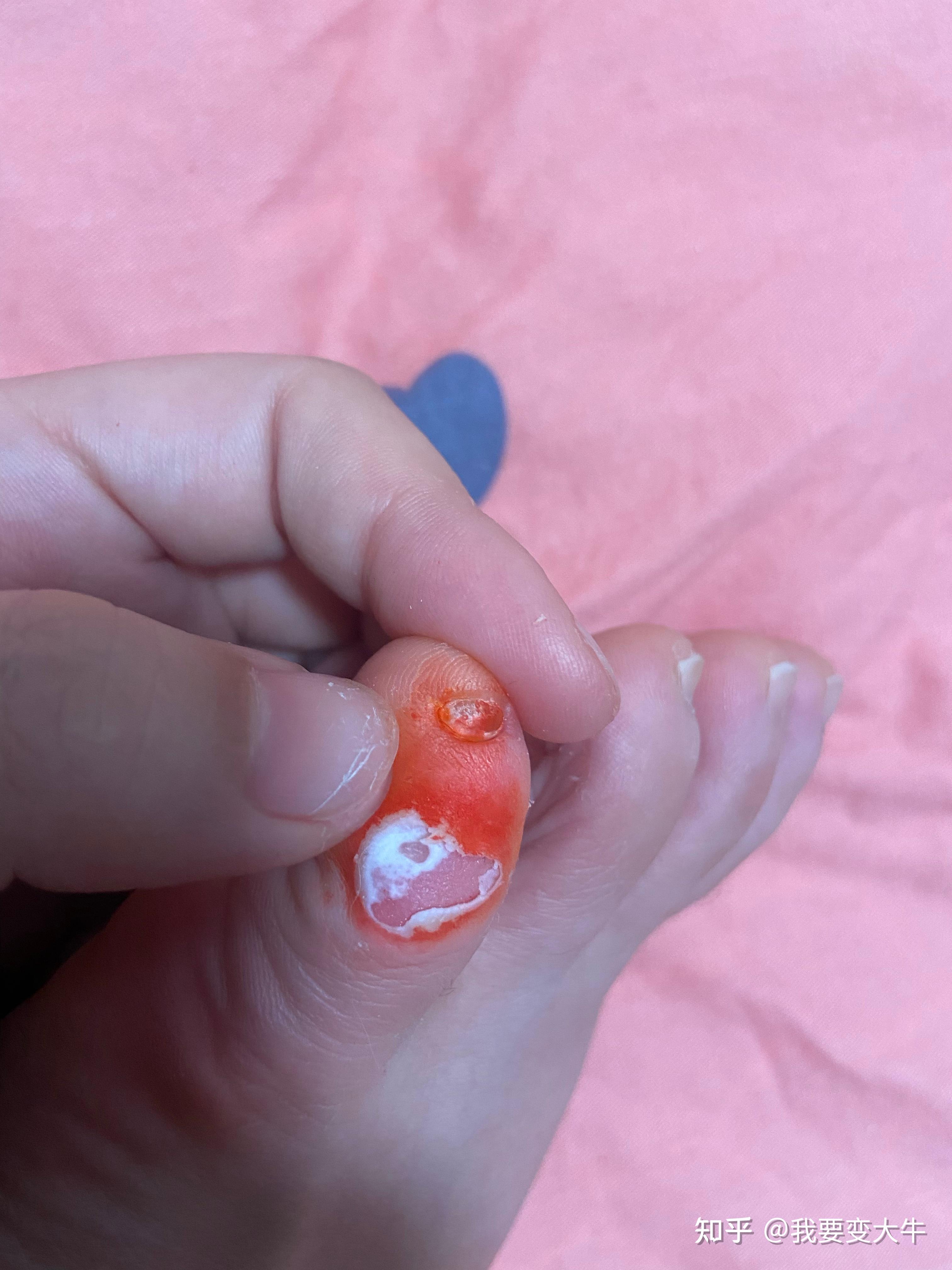 我的脚小拇指的外侧有个小茧子,好疼,按压疼,不能穿漂亮的高跟鞋,这是