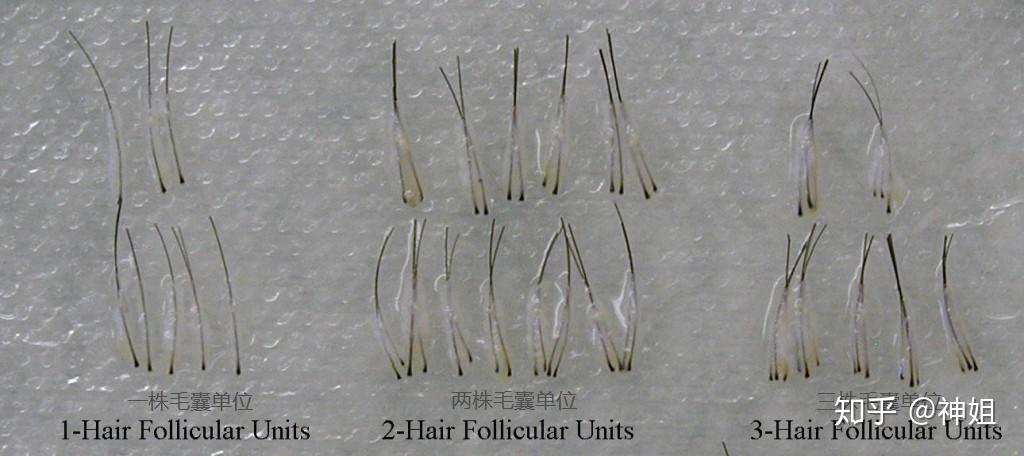 请问天生发量少能不能通过药物让毛囊头发根数变多从而整体发量增加