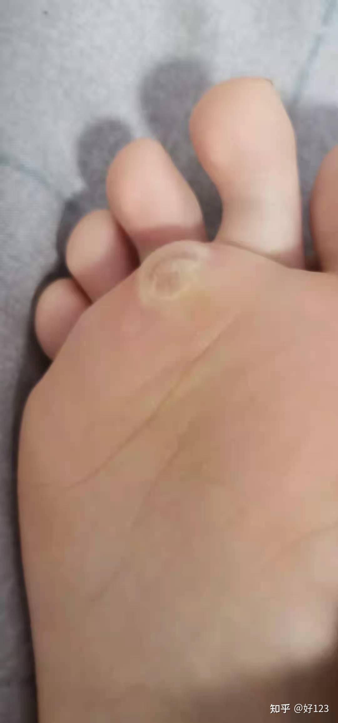 脚经常磨起水泡还适合做销售业务么? - 知乎