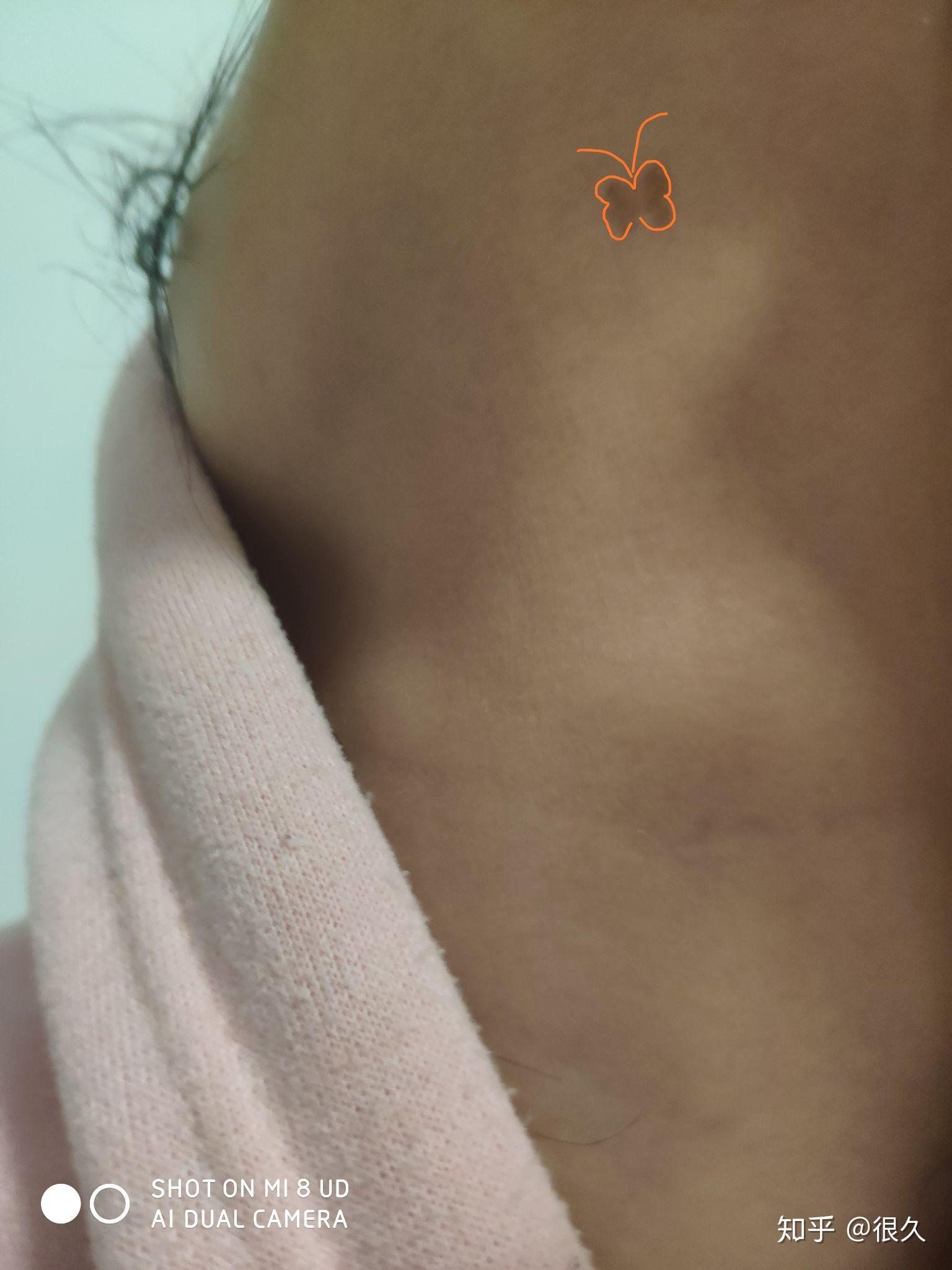 蝴蝶胎记代表什么