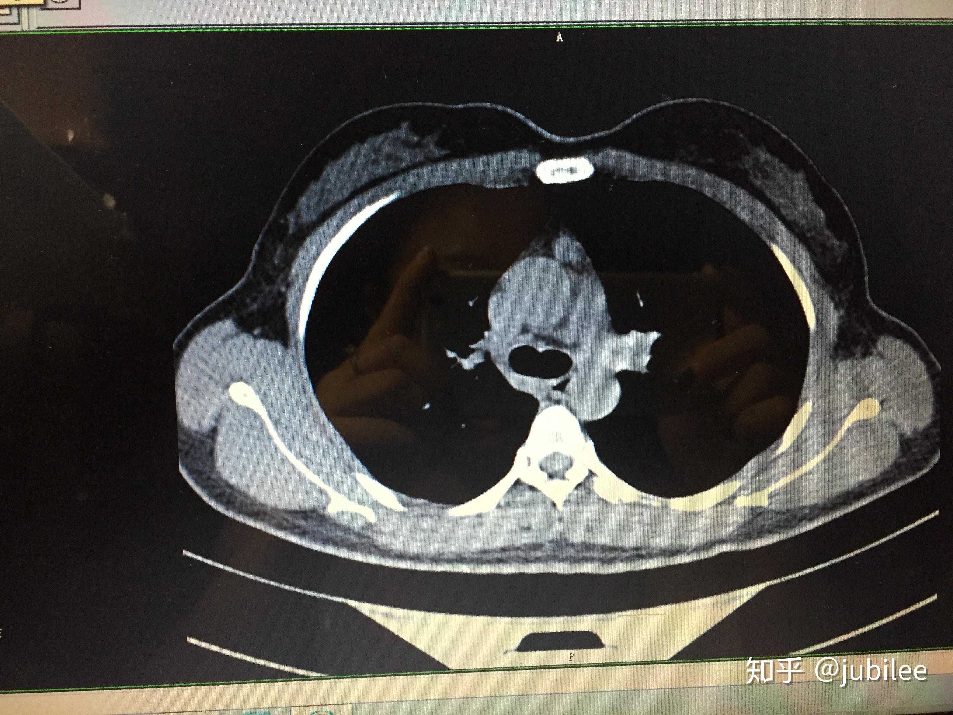 增强ct是否能判断胸腺瘤是良性还是恶性的