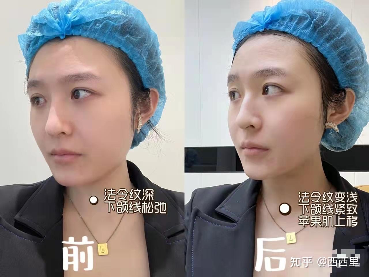 听说美版超声刀好贵这个国产的半岛超声炮性价比高吗