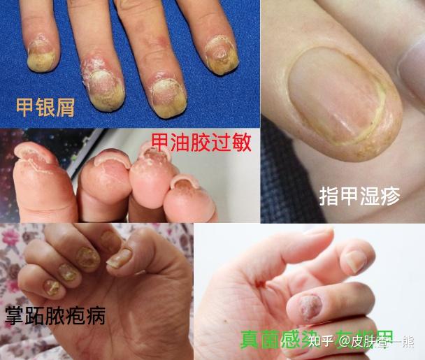 手指湿疹导致指甲变形然后烂掉了?