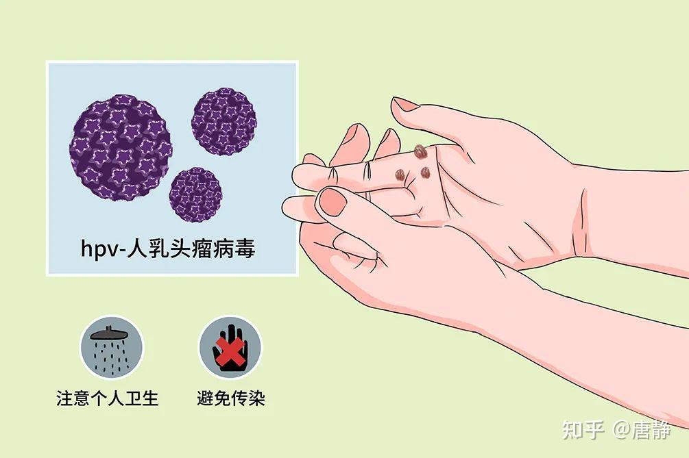 像痦子的扁平疣，实则HPV，竟能不治而愈？ - 知乎