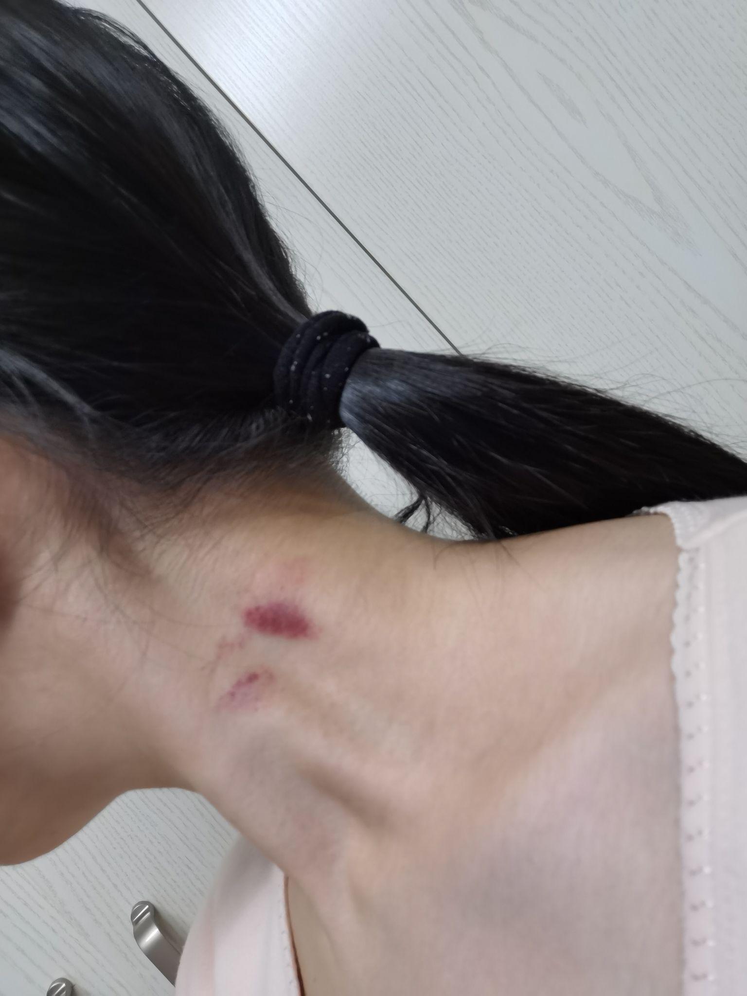 言情小说里的女主日常一身吻痕,身体不会有问题吗?