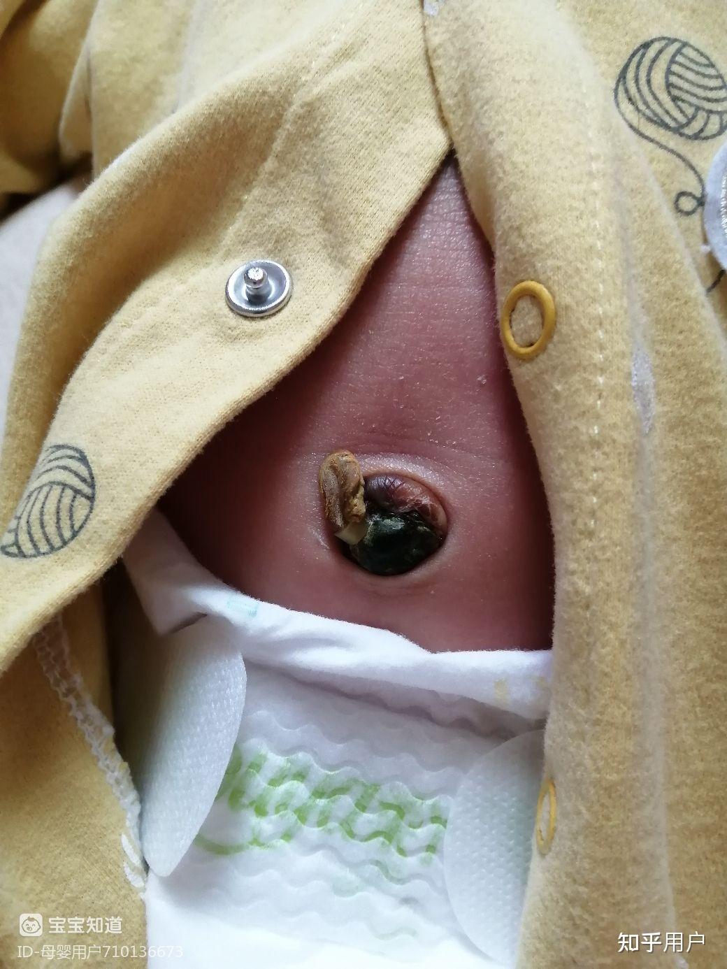 新生儿脐带消毒用碘酒好还是酒精好? - 知乎