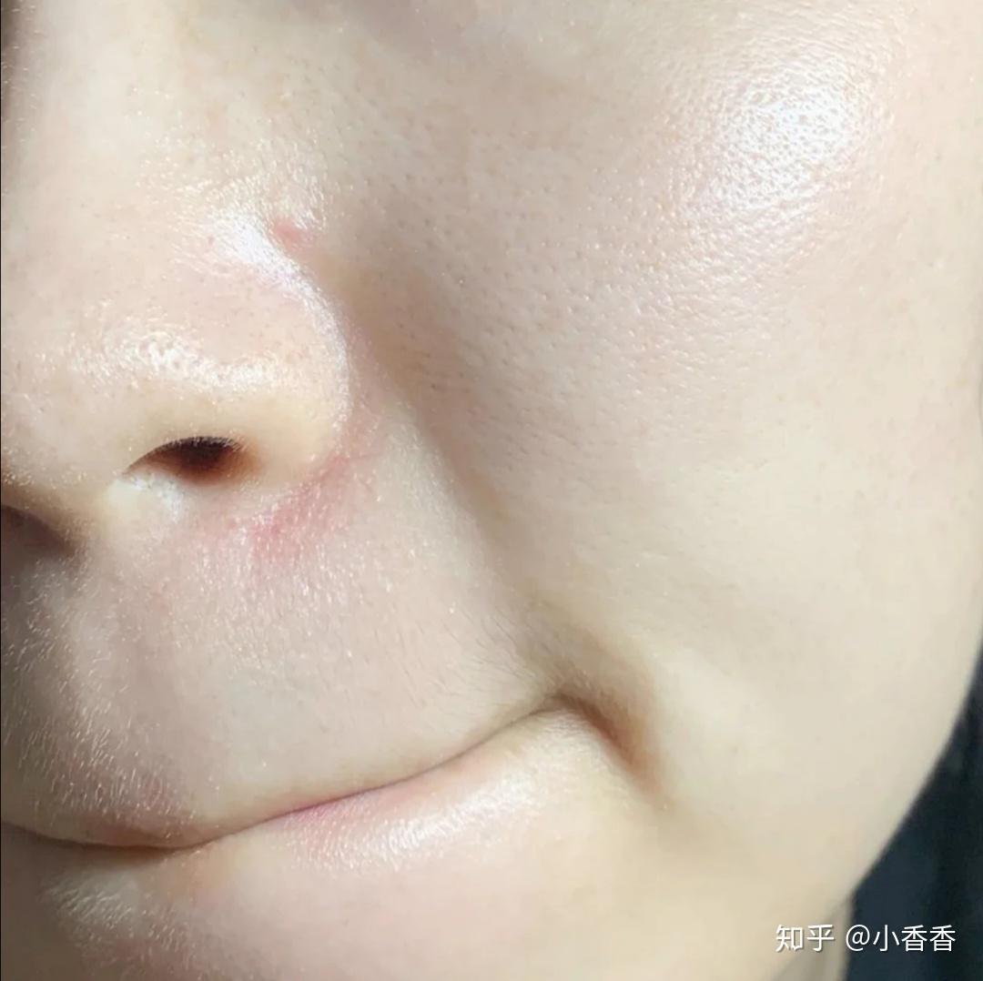 油皮毛孔粗大怎么改善?