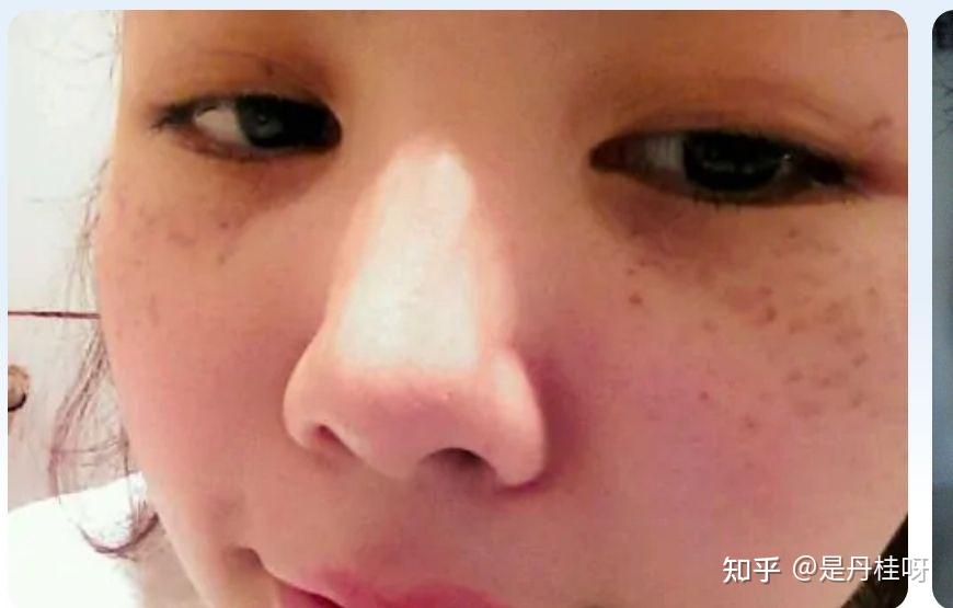 20岁左右的女生眼睛周围长斑什么原因啊