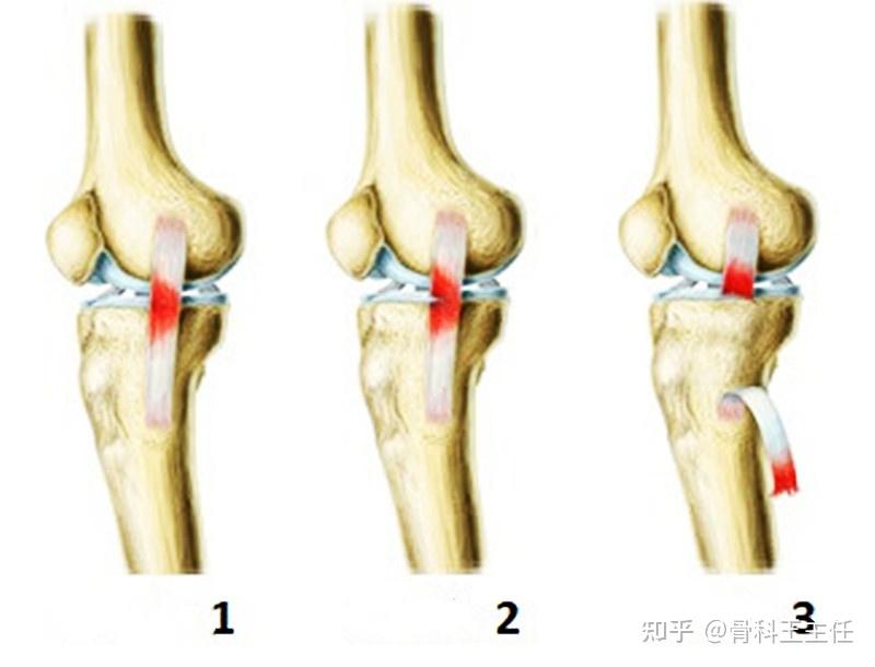 膝盖扭了一下,韧带撕裂分几级,怎么知道严重了? - 知乎