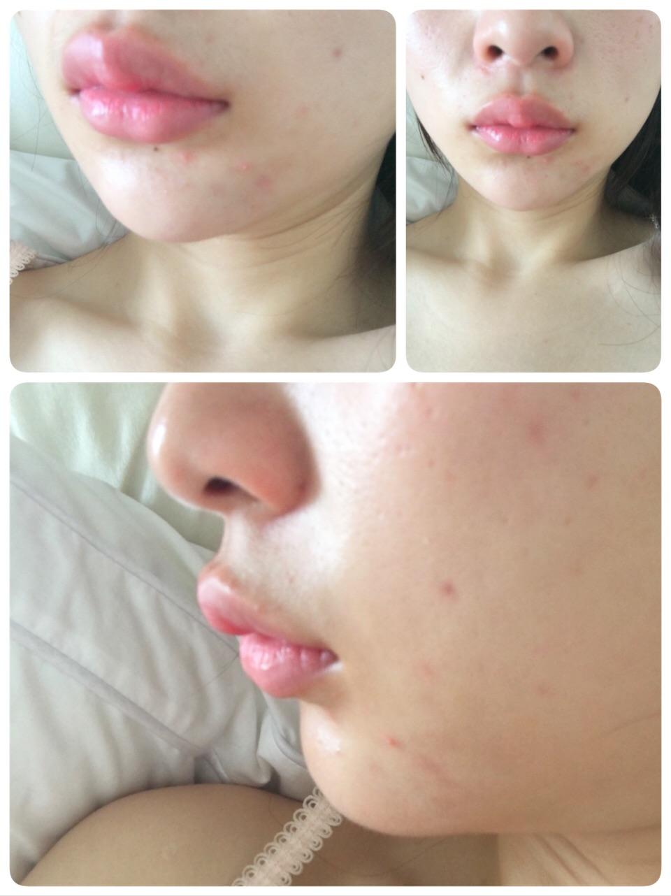 上嘴唇上翘上翻怎么办侧面看起来简直丑哭我