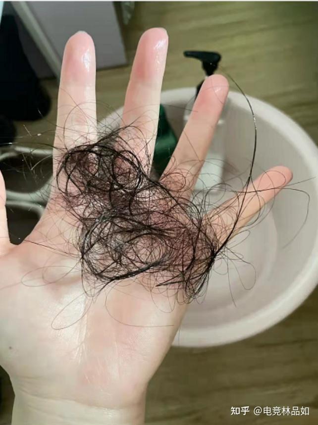 每天都大量掉头发怎么回事