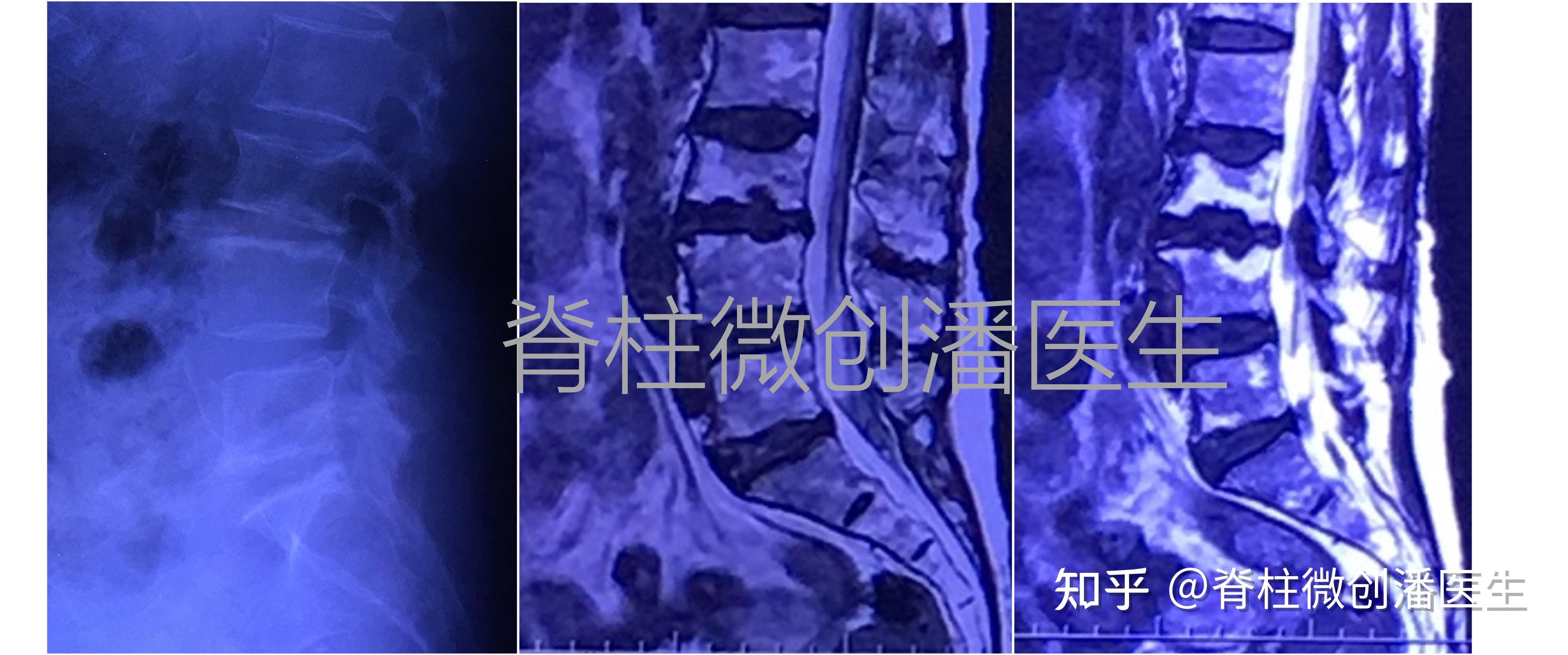 什么是Schmorl（许莫氏）结节？对身体有什么影响？ - 知乎