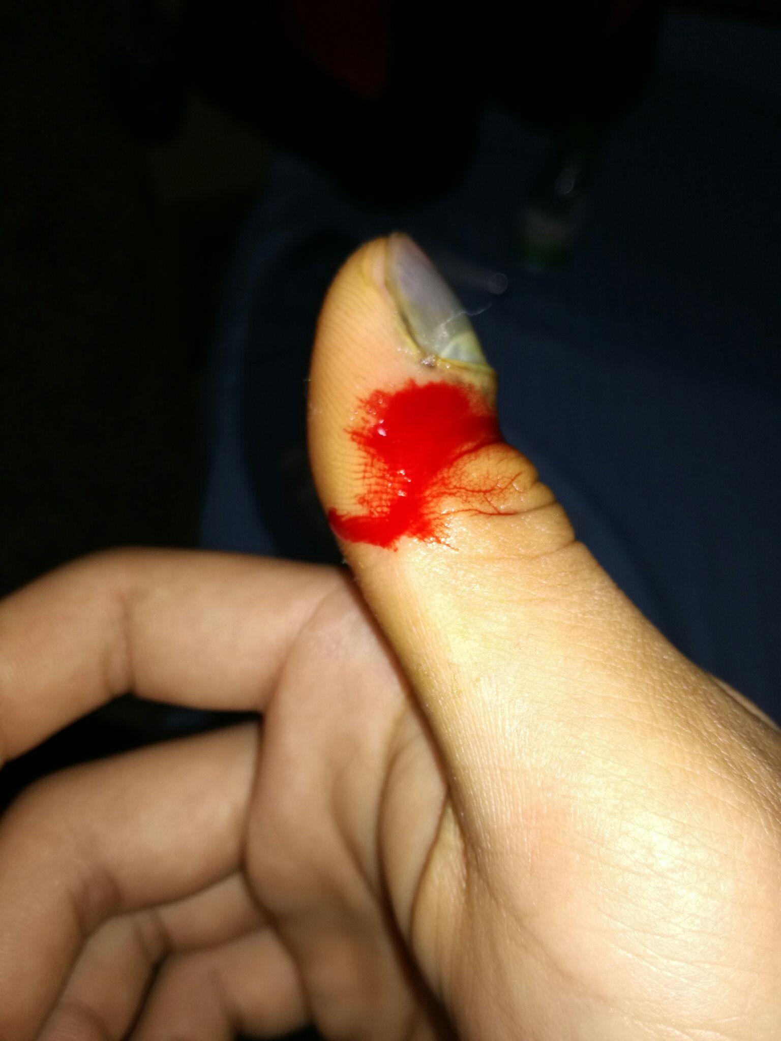 指甲被车门挤伤 指尖全是淤血 怎么办?