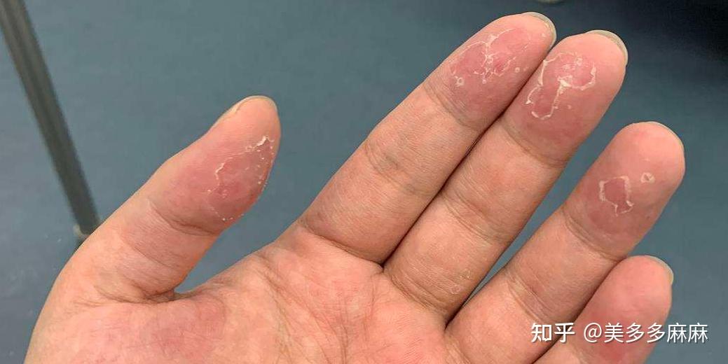 手脚脱皮怎么回事呢某小块区域变硬角化脱屑但不痒
