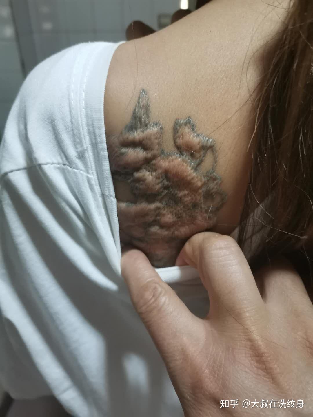 纹身洗掉后的疤痕图片图片