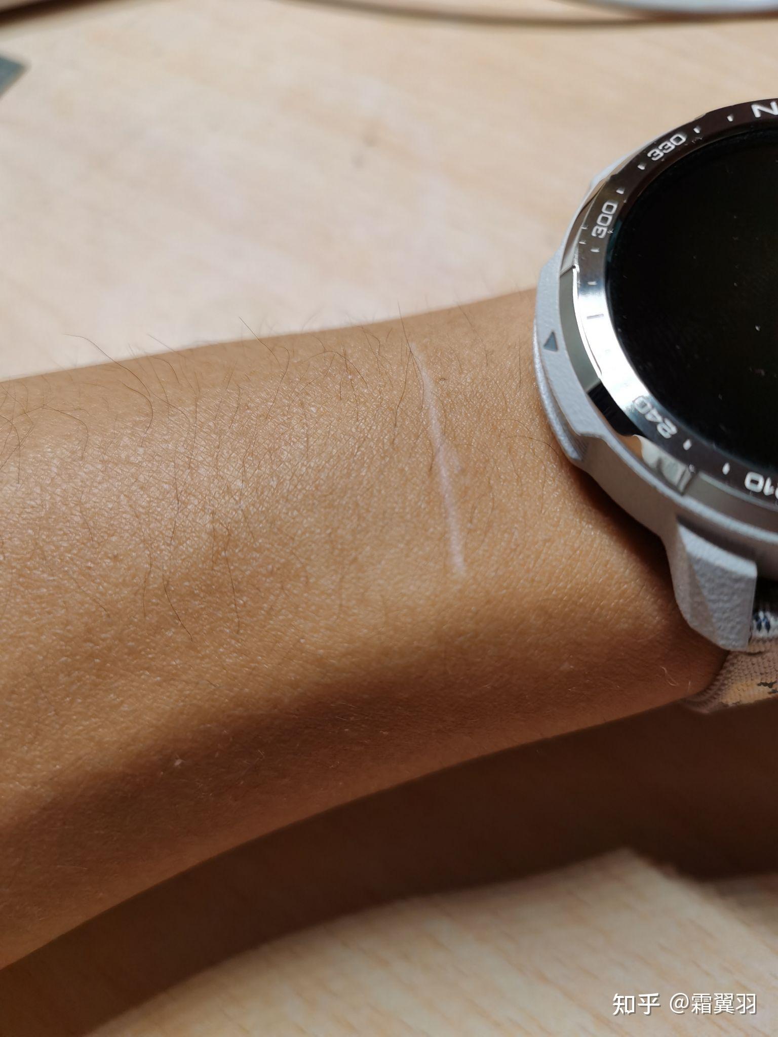 小臂有一条横向的白线是怎么肥四?