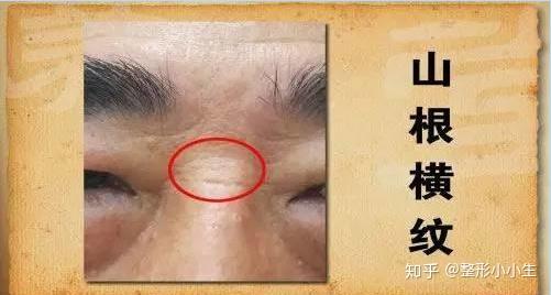 鼻横纹是怎样形成的?有没有方法可以改善呢? - 知乎