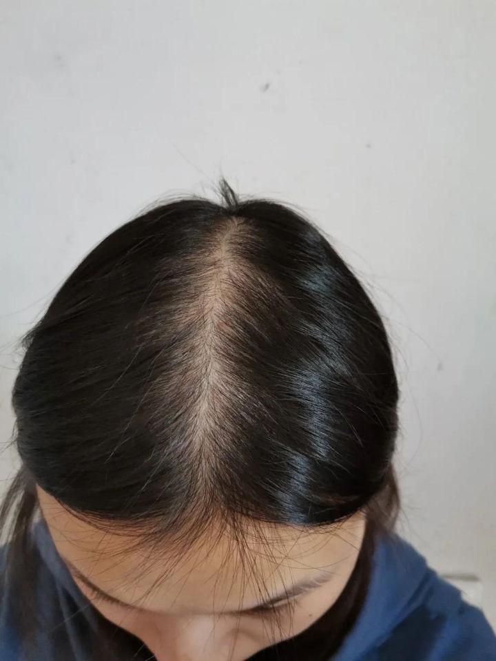 我这个发缝是不是要秃了?