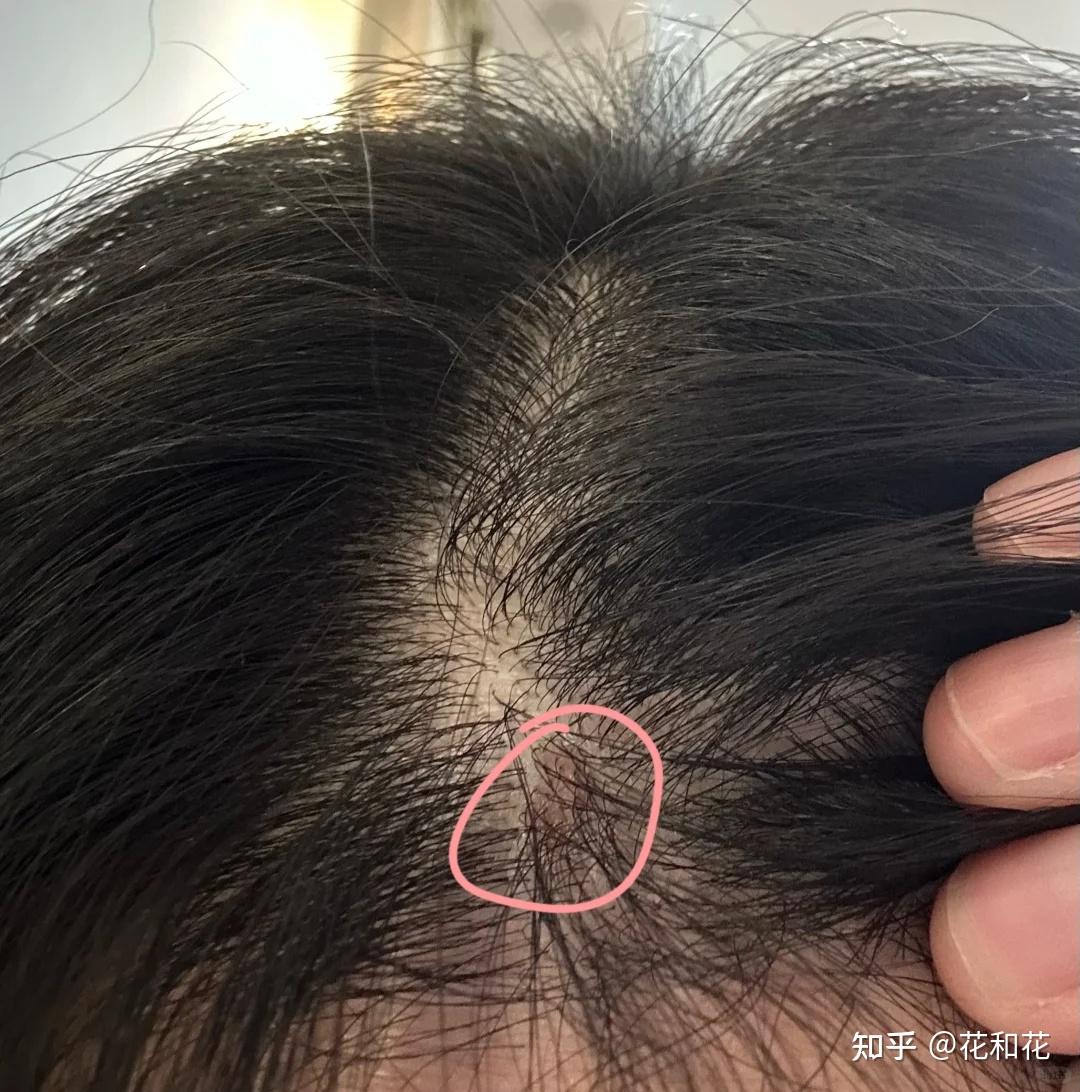 头皮痘痘总是反反复复！到底该怎样祛头皮痘啊？ - 知乎