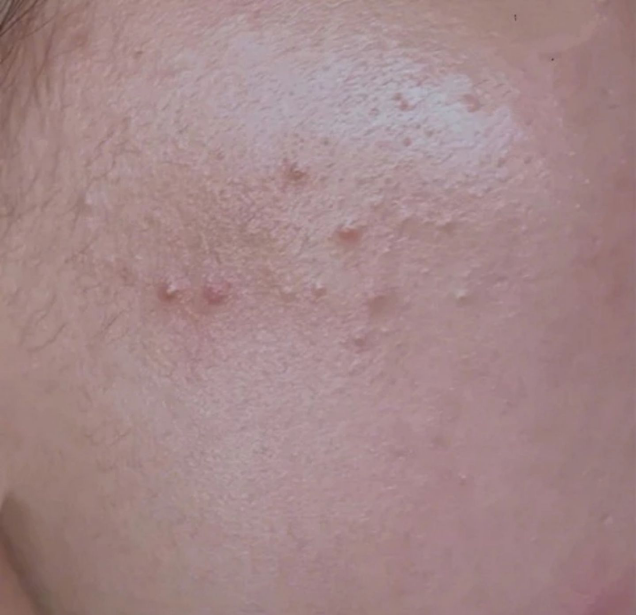 毛周角化长在脸颊两侧去除它适合什么洗面奶和水乳或者护肤品