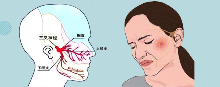 【就诊指南】三叉神经痛是哪里疼？该如何彻底“止痛”？ - 知乎