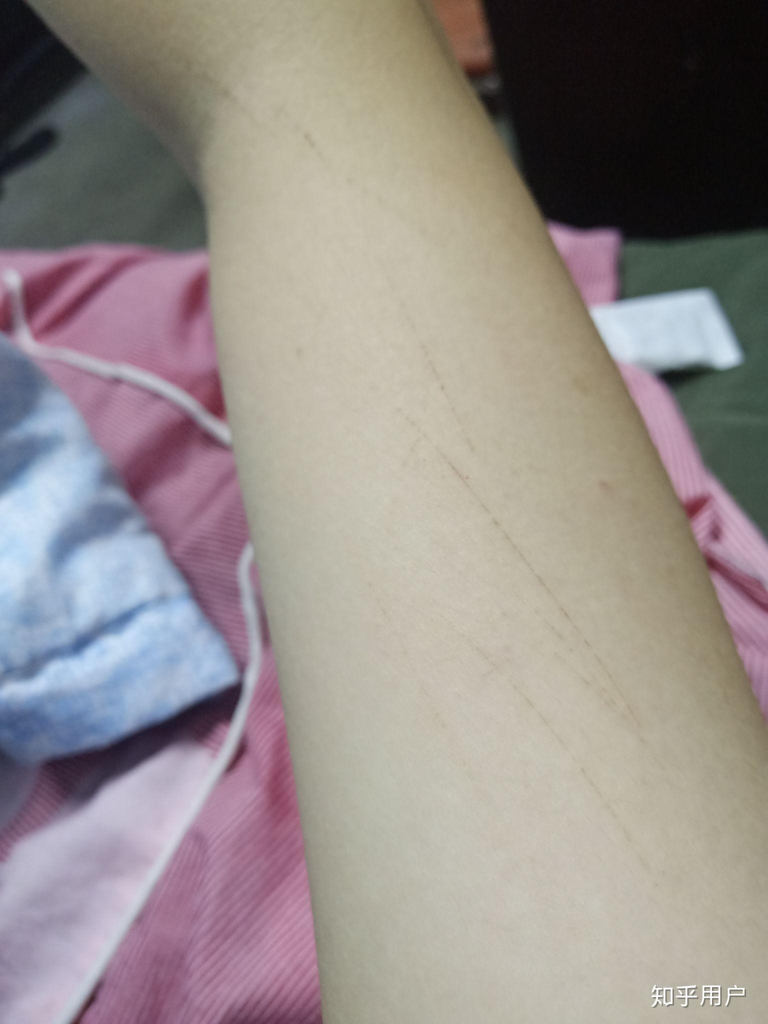 手臂莫名其妙出现伤痕是怎么回事?